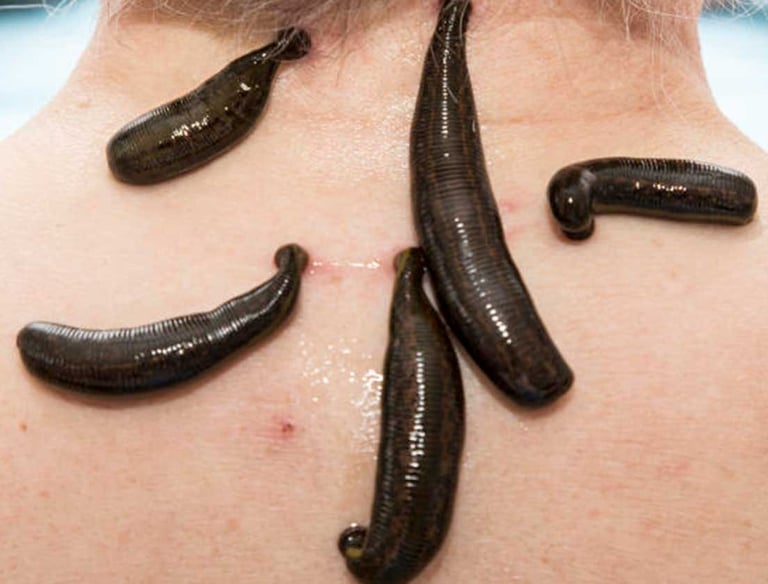Leech therapy used in a traditional clinical setting